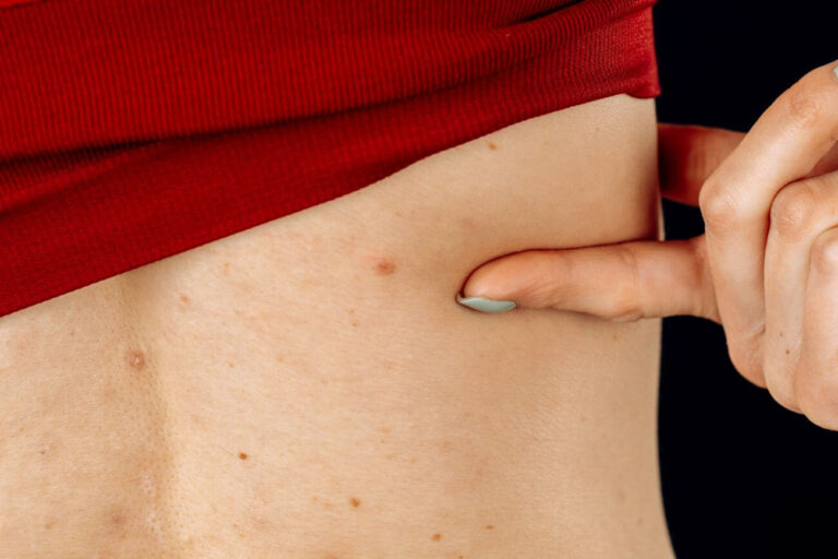 Jak walczyć z trądzikiem na plecach? Uporaj się z niedoskonałościami i zyskaj pewność siebie Jak walczyć z trądzikiem na plecach